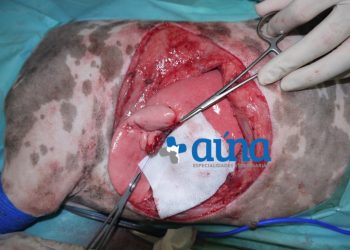 Cirugía resección pared costal 16