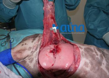 Cirugía resección pared costal 18