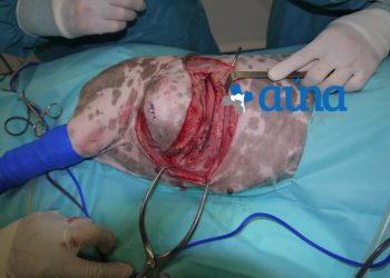 Cirugía resección pared costal 6